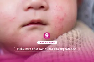 Chăm Sóc Mẹ Bé: Phân Biệt Rôm Sảy, Chàm Sữa Trị Tận Gốc