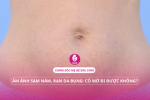 Chăm sóc sau sinh: Mẹo đánh bay sạm nám, rạn da bụng